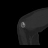 SPORK, NICO - 22.03.1976 - 02.08.2022 - CT obere Extremität - 17:59:07
